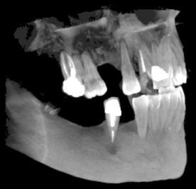 3D скенер на зъби – две челюсти
