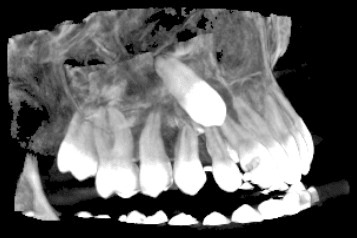 3D скенер на зъби – една челюст