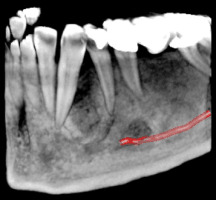 3D скенер на зъби – сектор