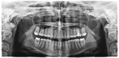 Панорамна снимка на зъби (OPG)